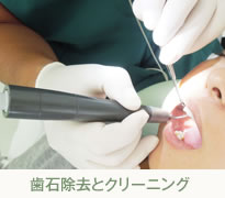 歯石除去とクリーニング