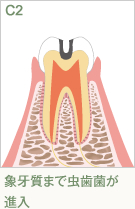 象牙質まで虫歯菌が進入