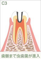 歯髄まで虫歯菌が進入