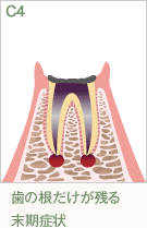 歯の根だけが残る末期症状